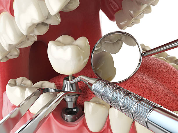 Best Emergency Dentist for Lost Fillings or Crowns in Northampton, MA